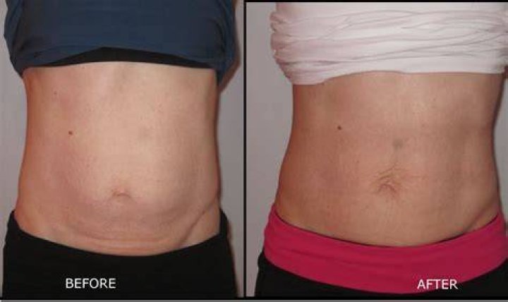 Before & After Diastasis Recti Repair Gallery Holistic Core Restore