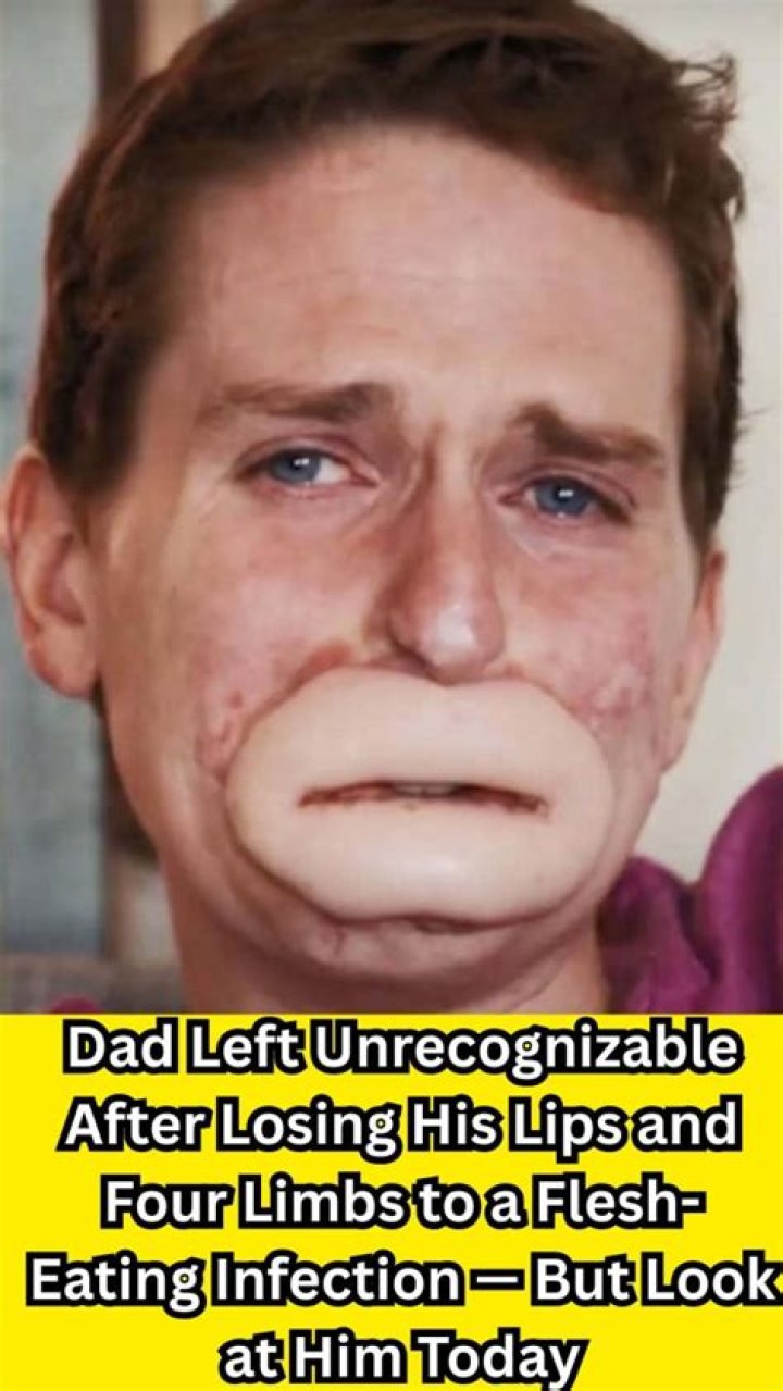 Dad left unrecognizable after losing his lips and four limbs to flesh