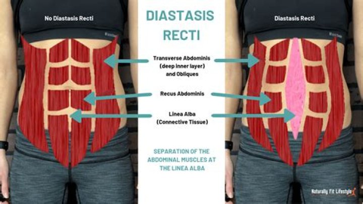 Diastasis Recti Do You Have It? Plus How to Treat It