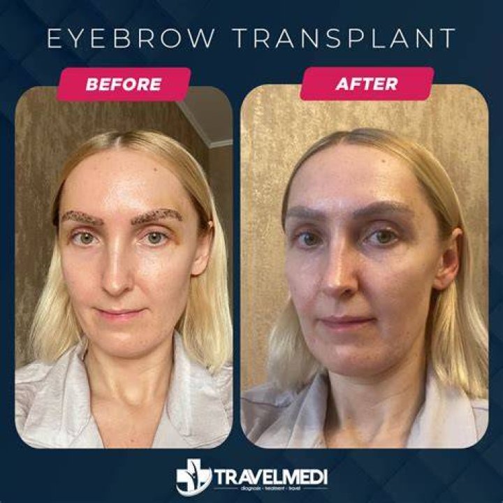 Eyebrow Transplant Before And After Photos Woman and Girls