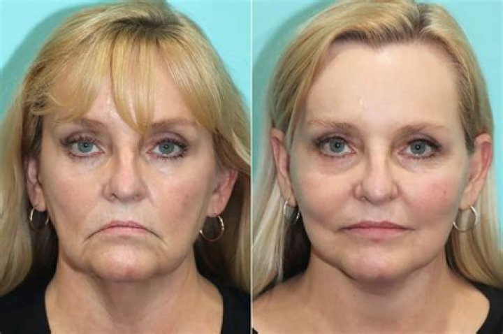 Plastic Surgery Chevy Chase, MD & Herndon, VA Shervin Naderi, MD, FACS